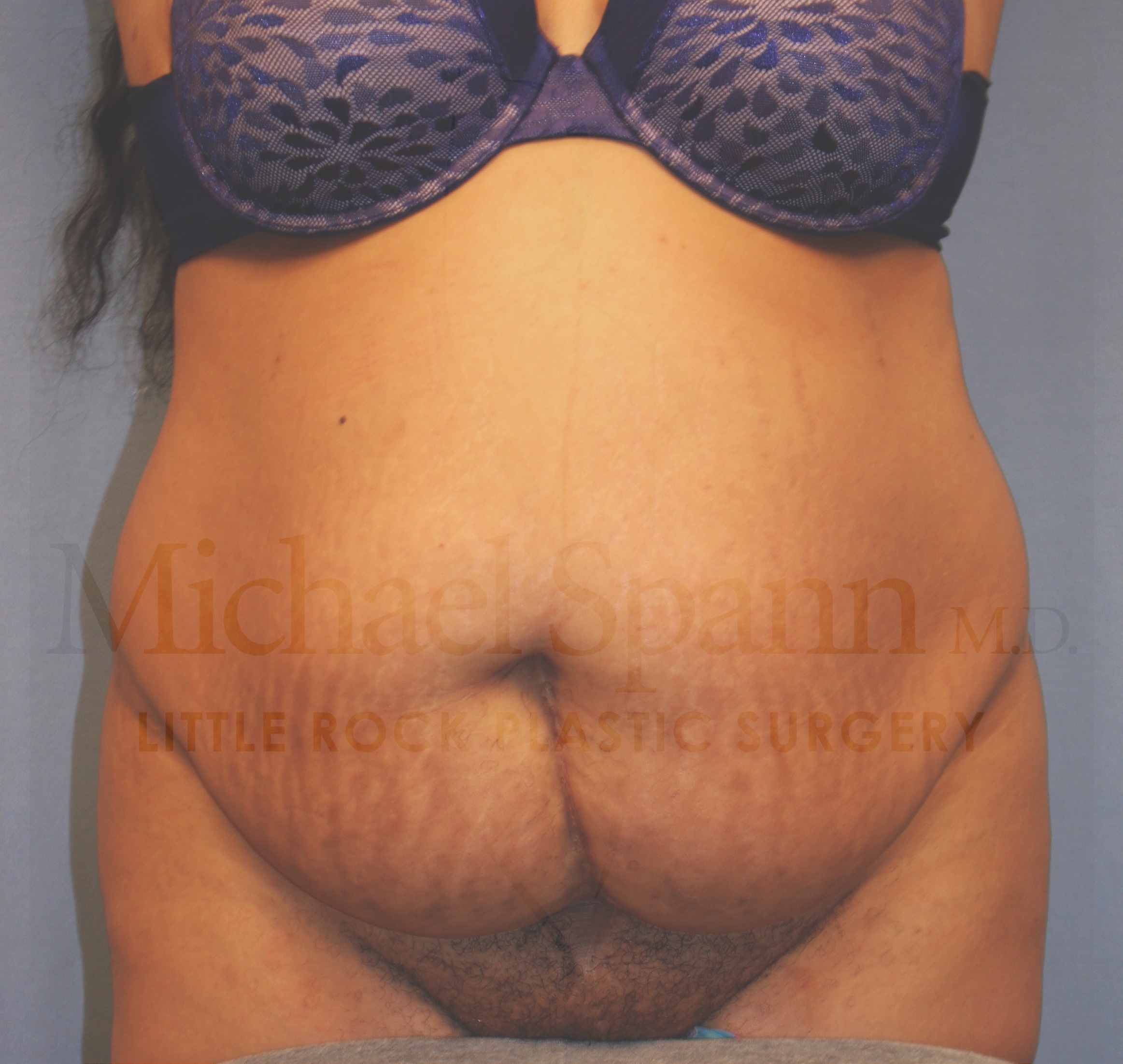 before image of Tummy Tuck Little Rock AR