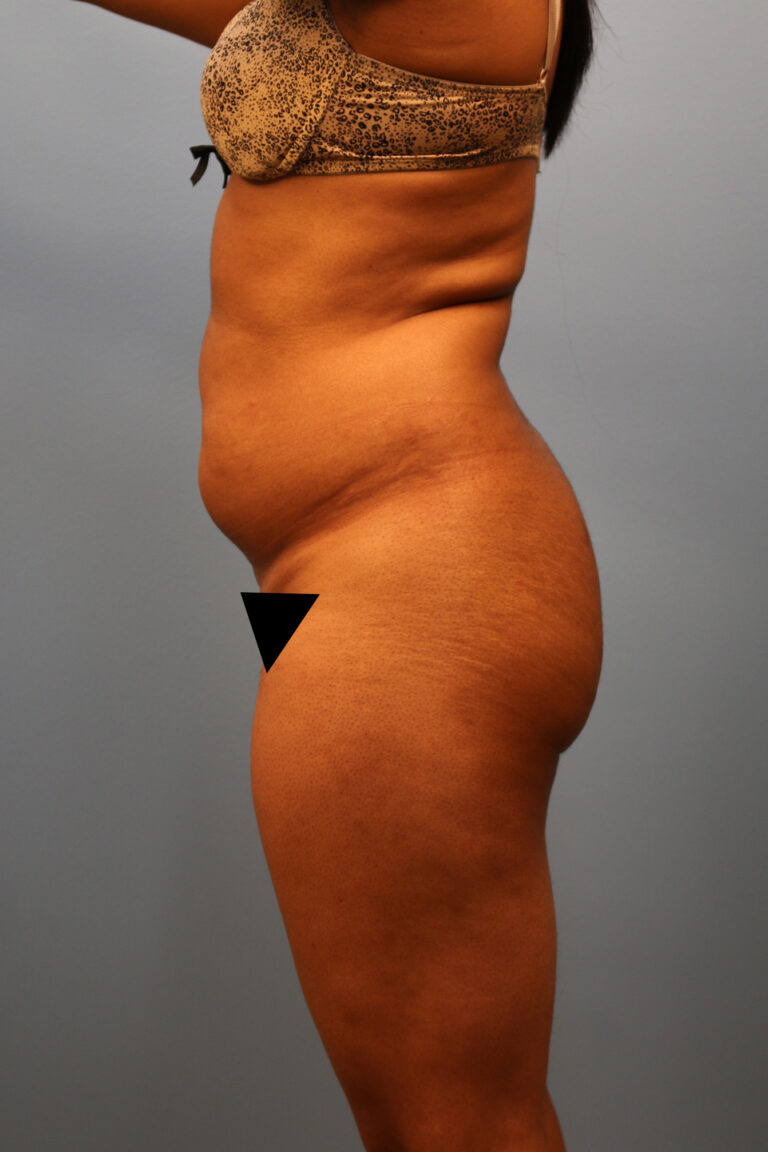Before Image: BBL - left-side