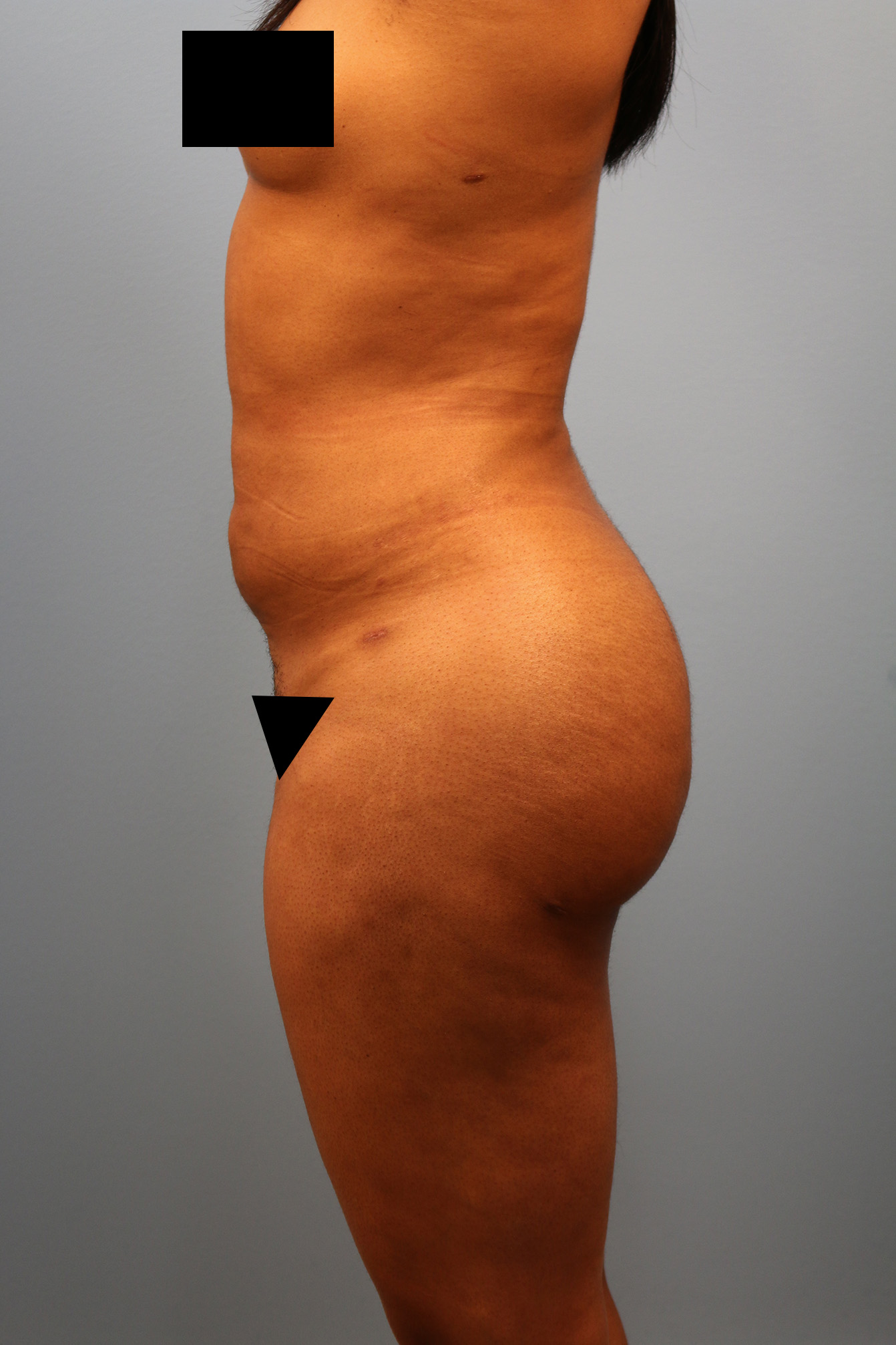 After Image: BBL - left-side