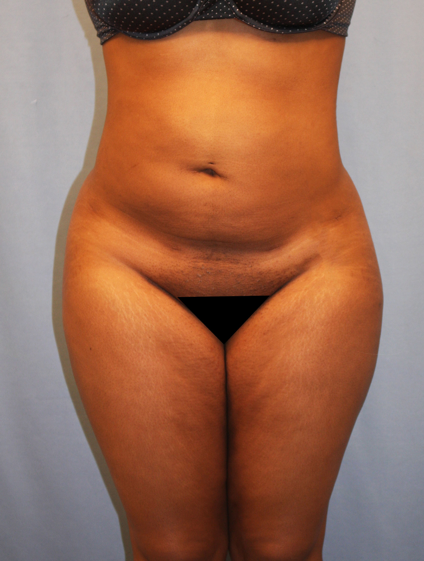 After Image: BBL - front