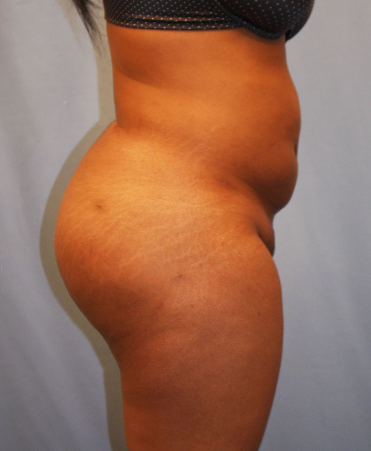 After Image: BBL - right-side