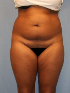 Before Image: BBL