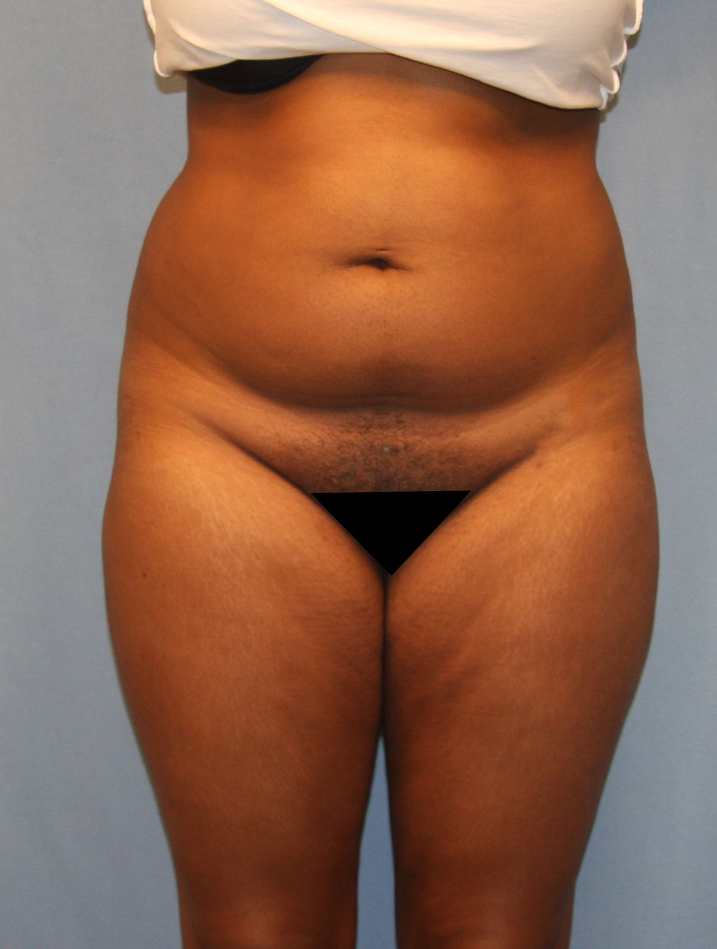 Before Image: BBL - front