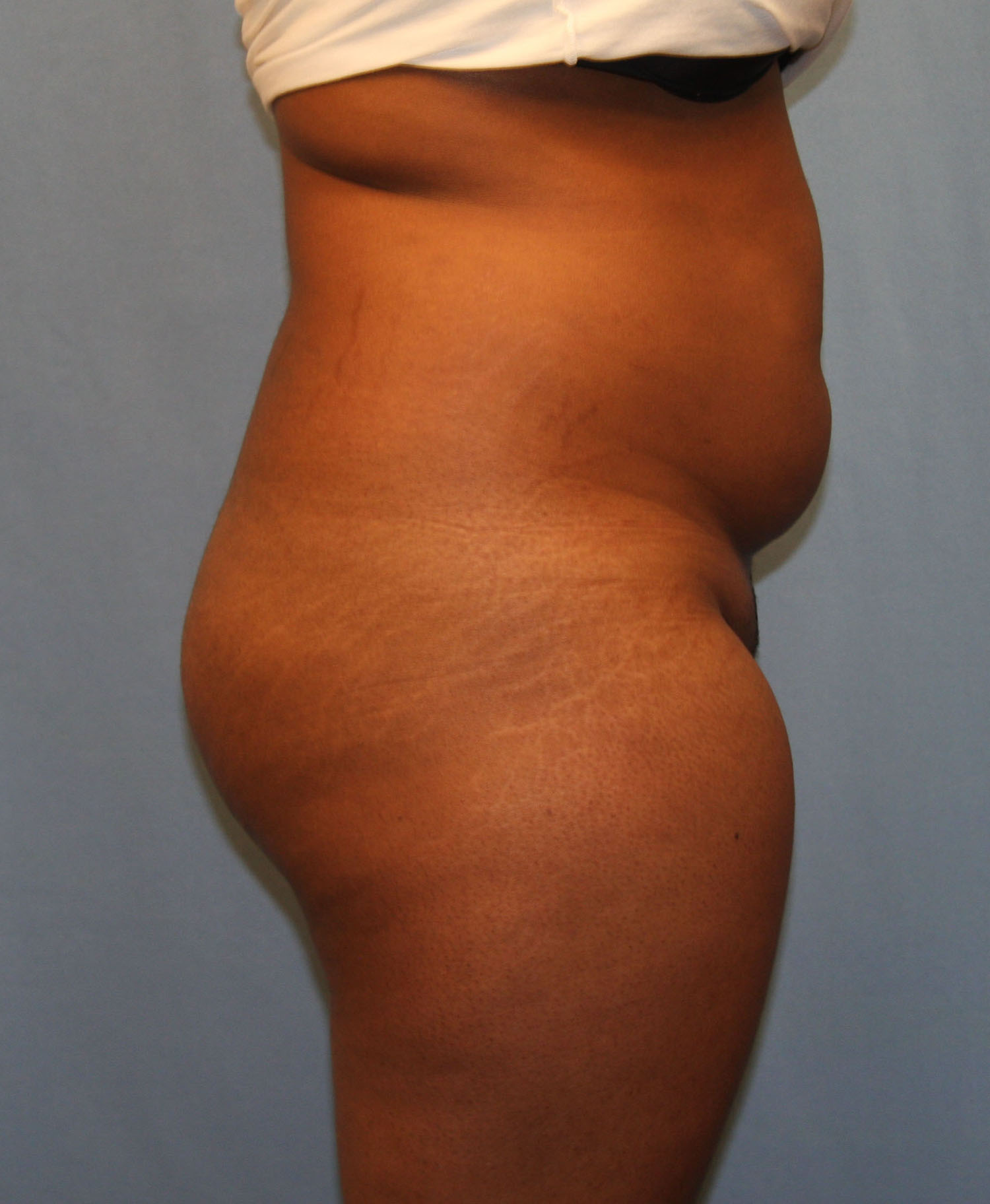 Before Image: BBL - right-side