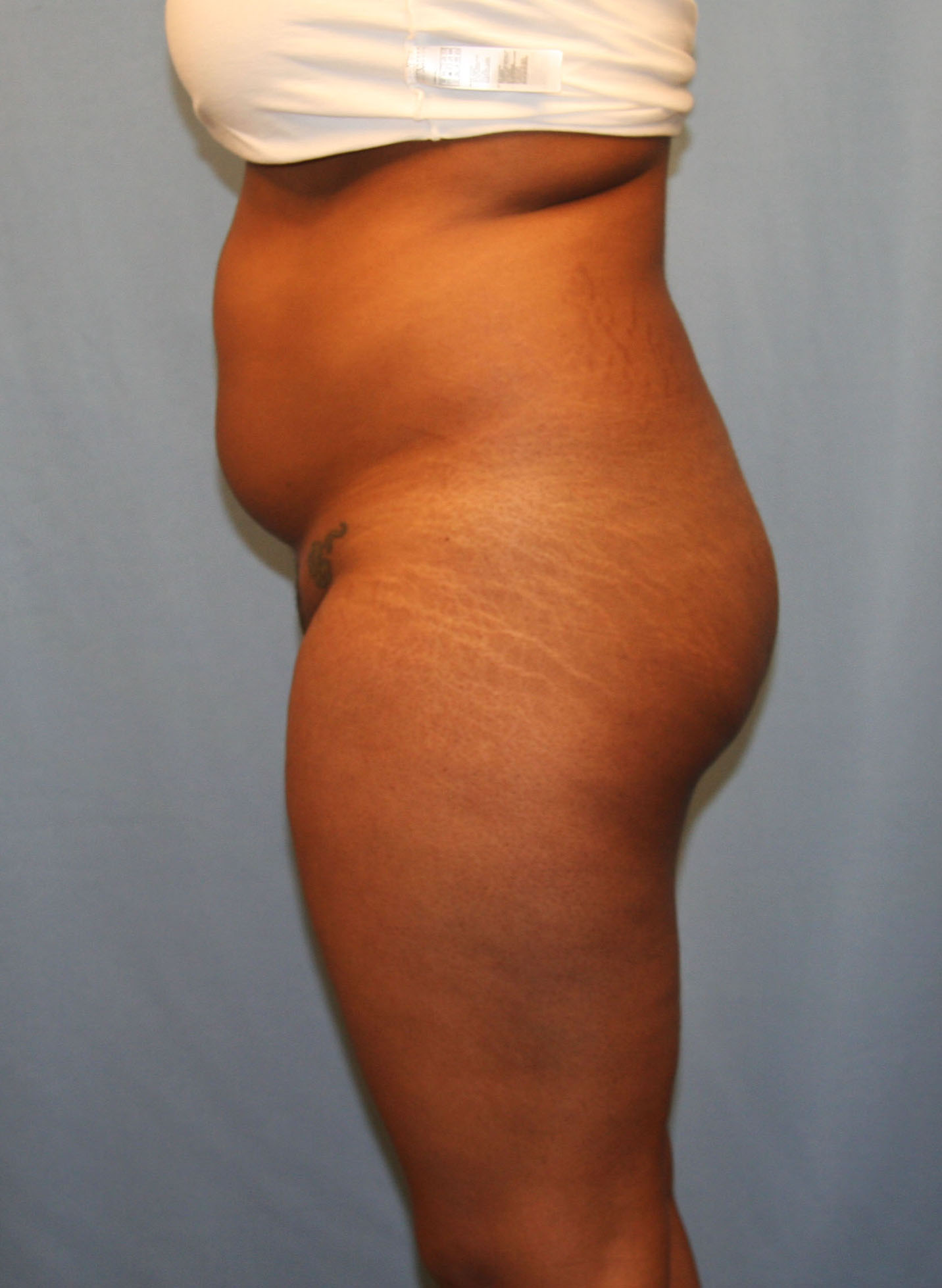 Before Image: BBL - left-side