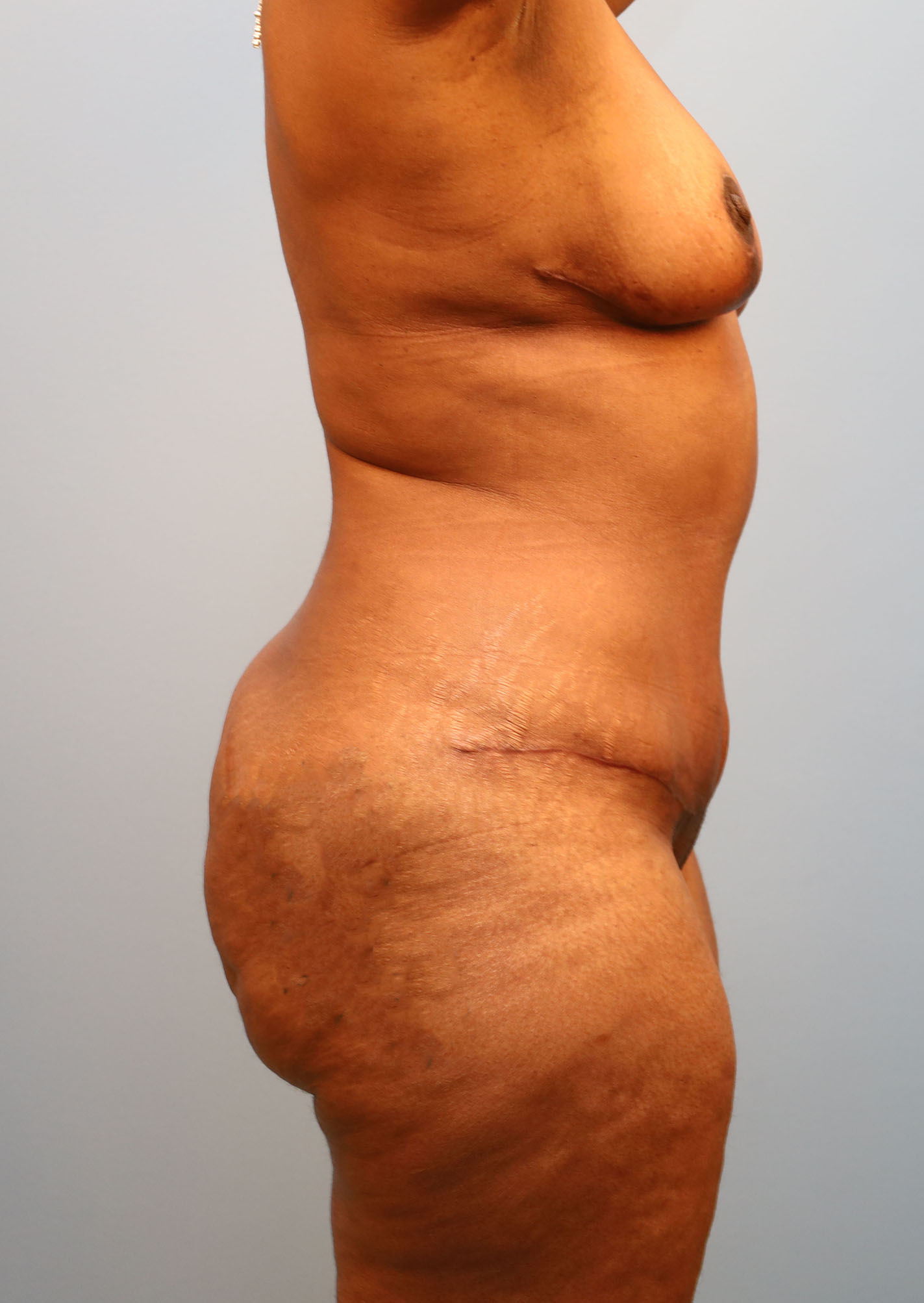 After Image: Breast Lift and Tummy Tuck - right-side