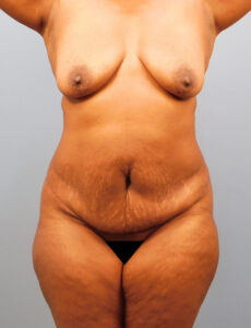 Before Image: Breast Lift and Tummy Tuck