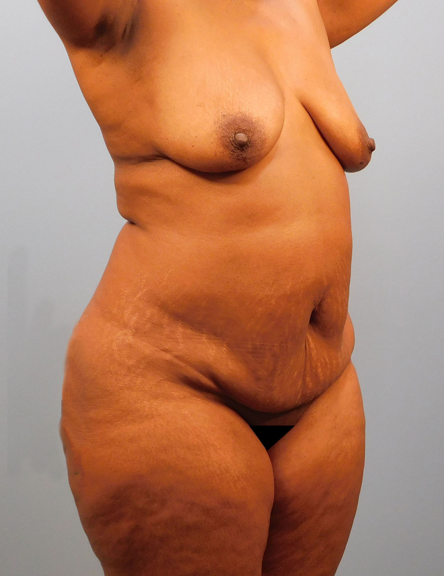 Before Image: Breast Lift and Tummy Tuck - right-front-oblique