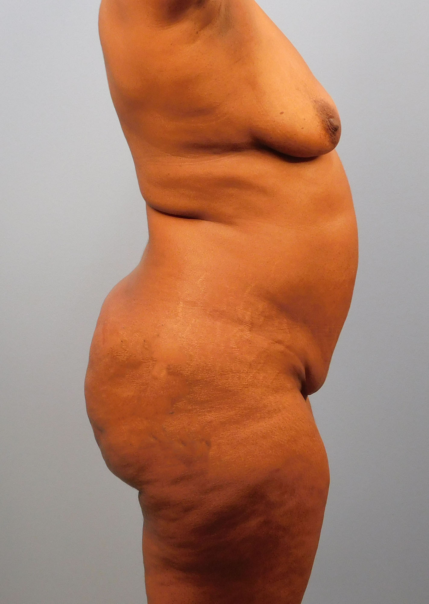 Before Image: Breast Lift and Tummy Tuck - right-side