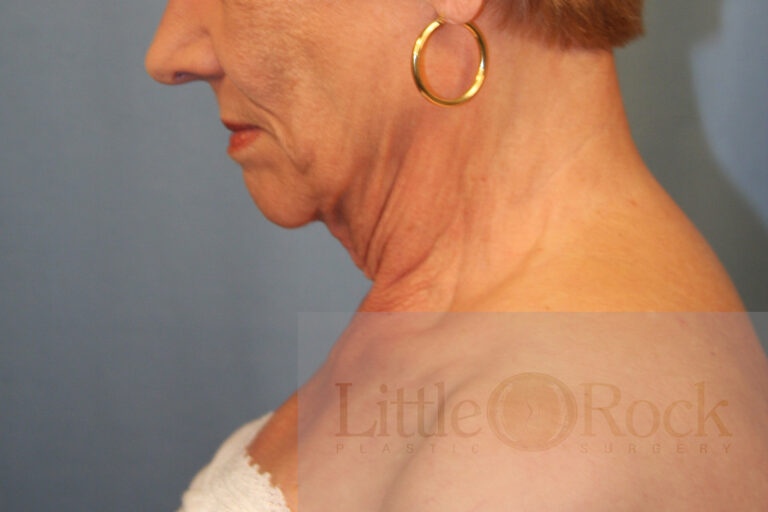 Before Image: Neck Lift - left-side