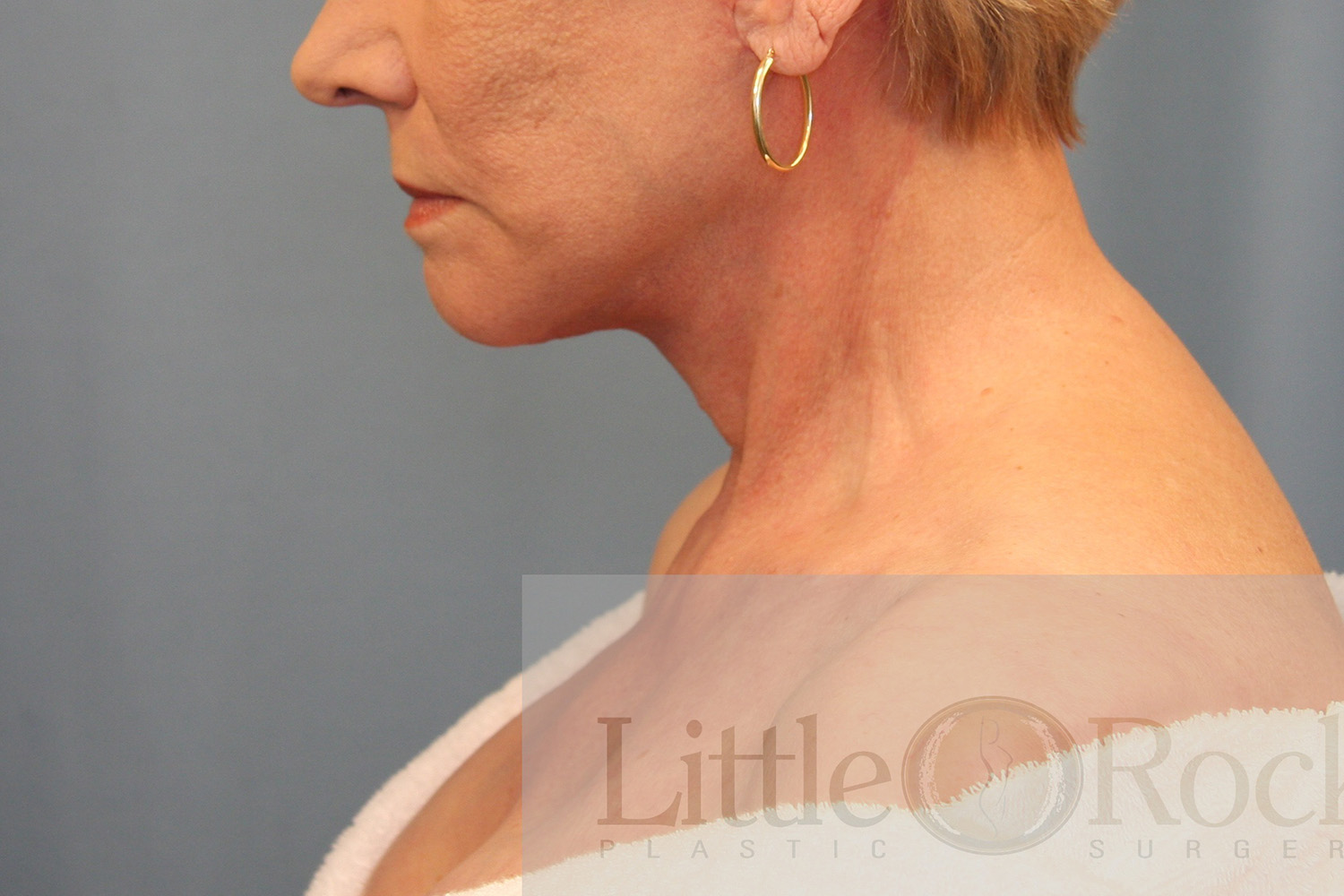 After Image: Neck Lift - left-side