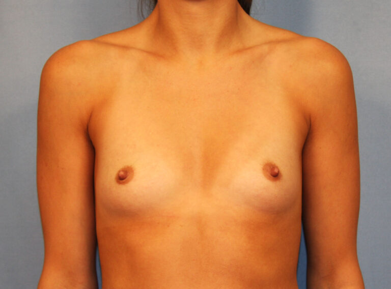 Before Image: Breast Augmentation with Mastopexy - front