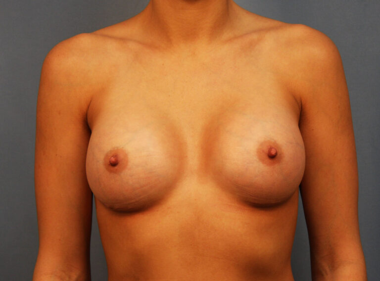After Image: Breast Augmentation with Mastopexy - front
