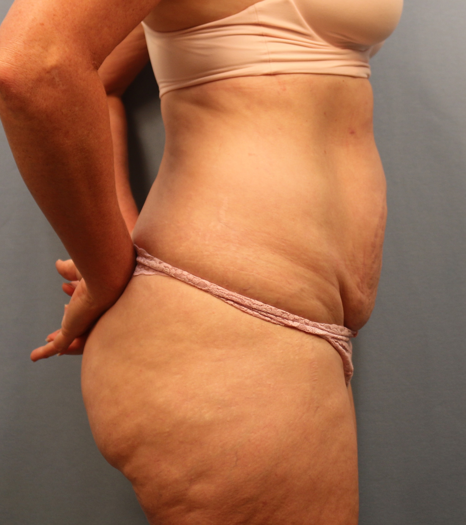 Before Image: Tummy Tuck - right-side