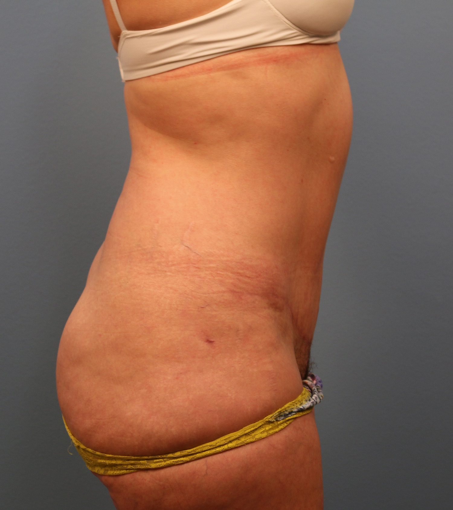 After Image: Tummy Tuck - right-side