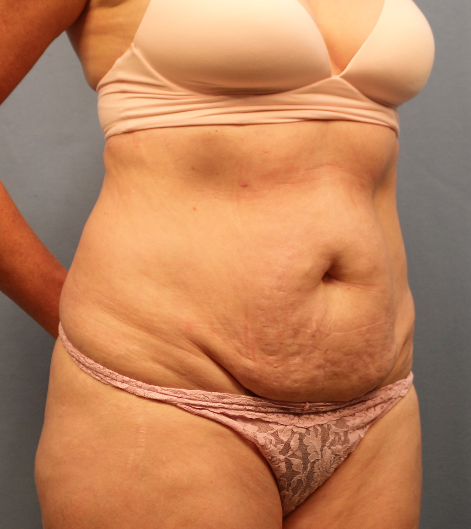 Before Image: Tummy Tuck - right-front-oblique