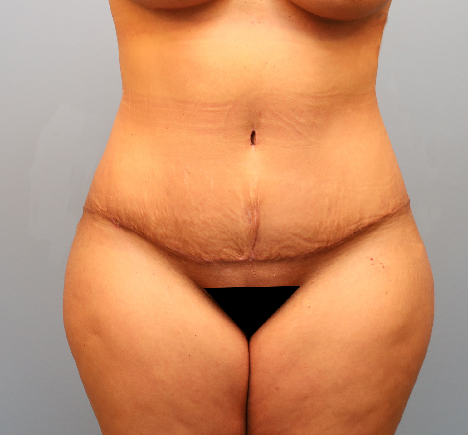 After Image: Tummy Tuck - front