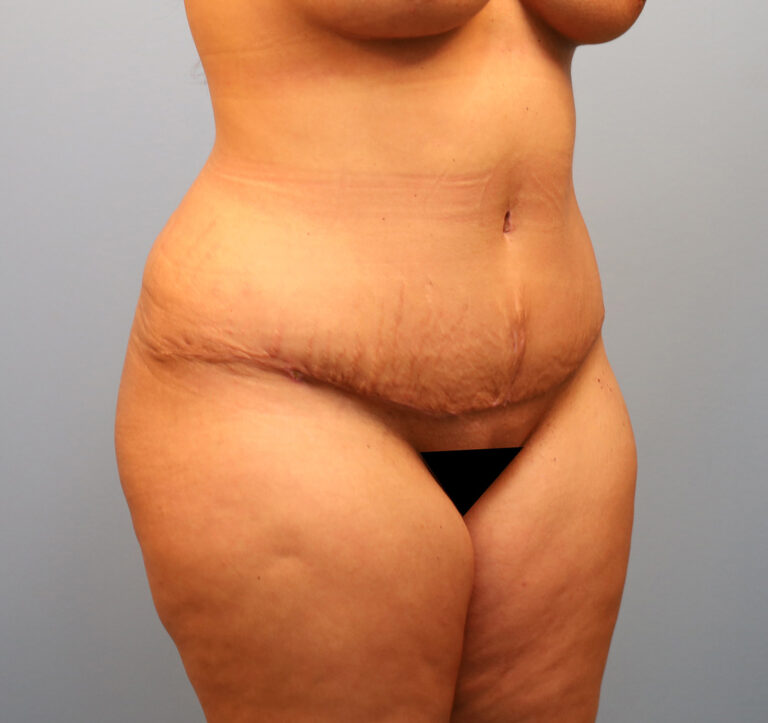 After Image: Tummy Tuck - right-front-oblique