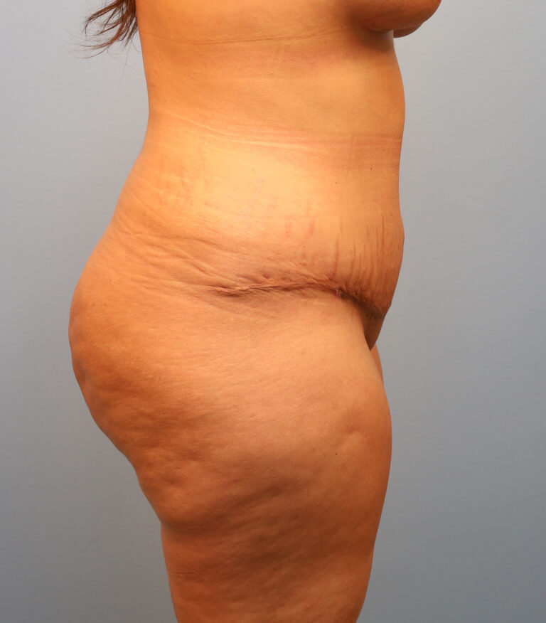 After Image: Tummy Tuck - right-side