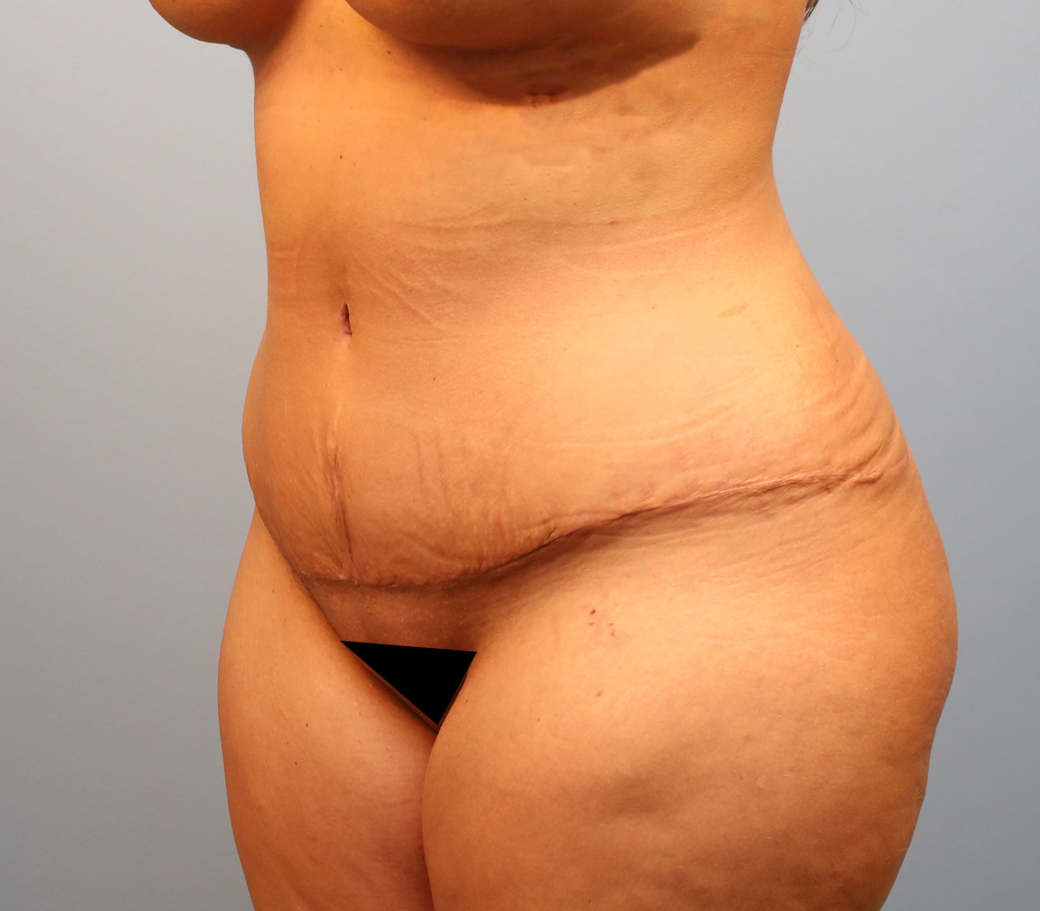 After Image: Tummy Tuck - left-front-oblique