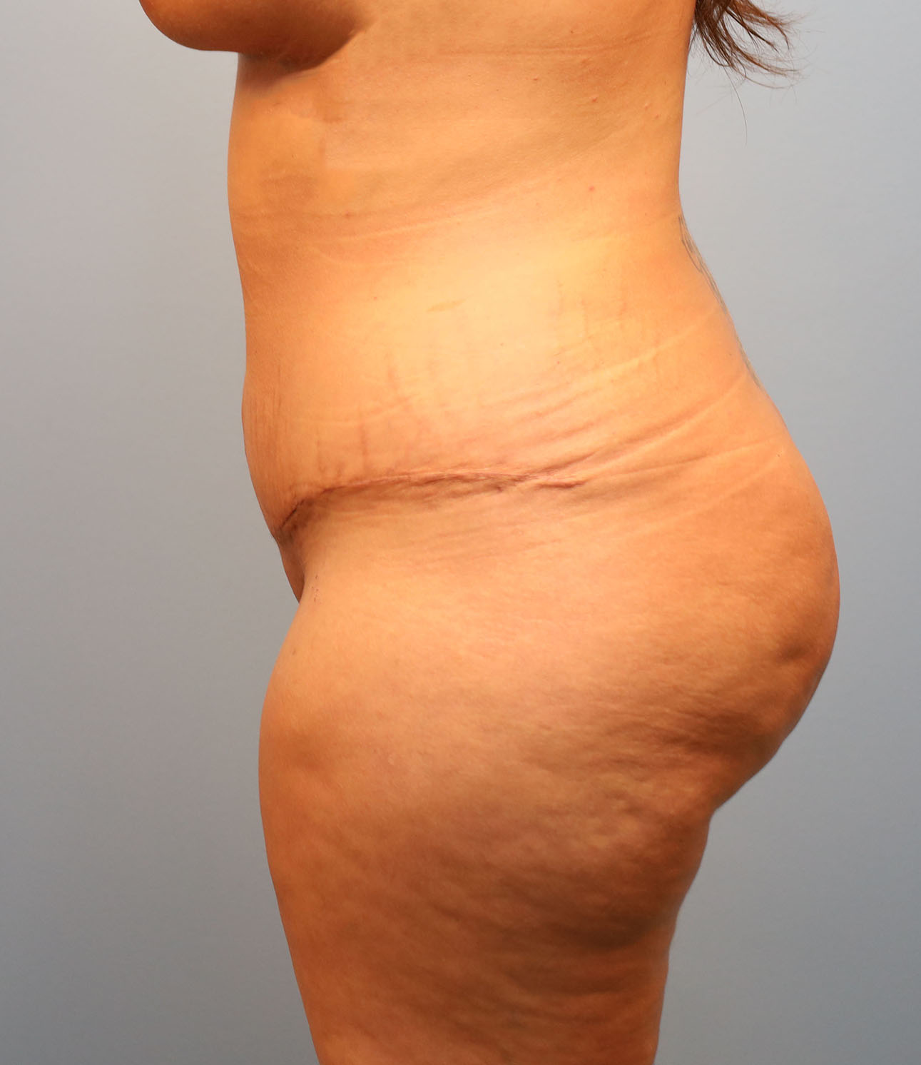 After Image: Tummy Tuck - left-side