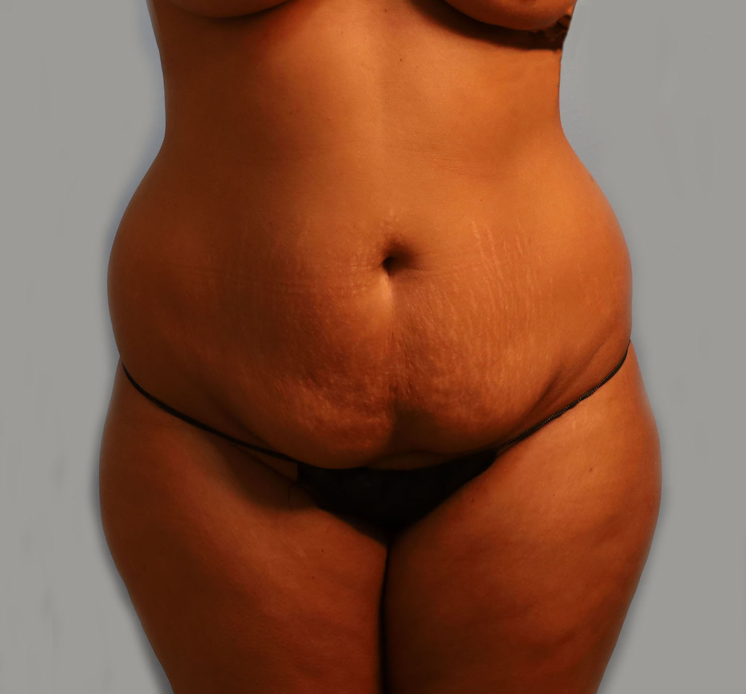 Before Image: Tummy Tuck - front