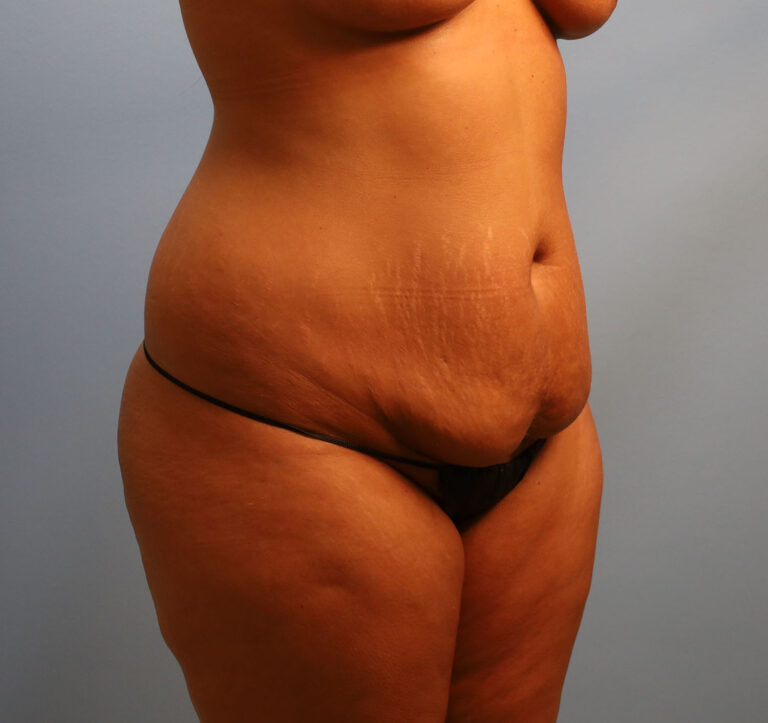 Before Image: Tummy Tuck - right-front-oblique