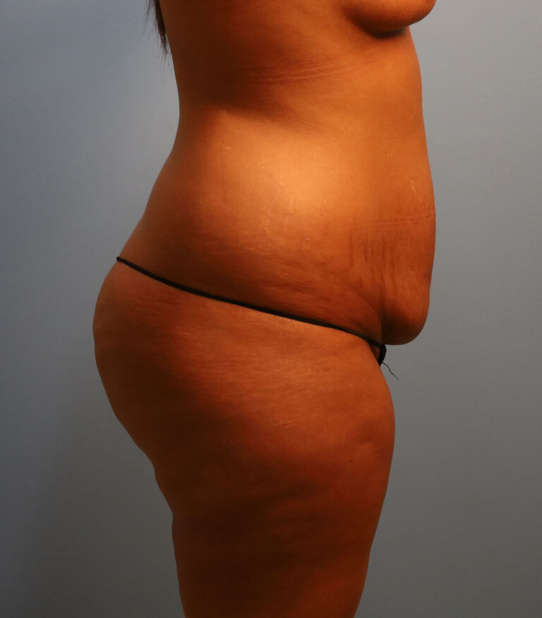 Before Image: Tummy Tuck - right-side