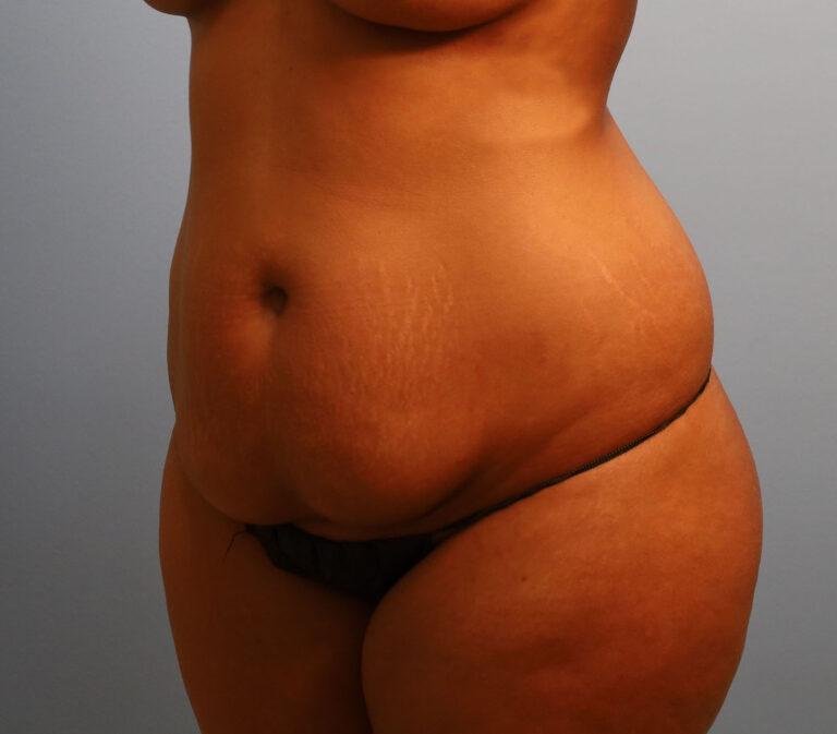 Before Image: Tummy Tuck - left-front-oblique