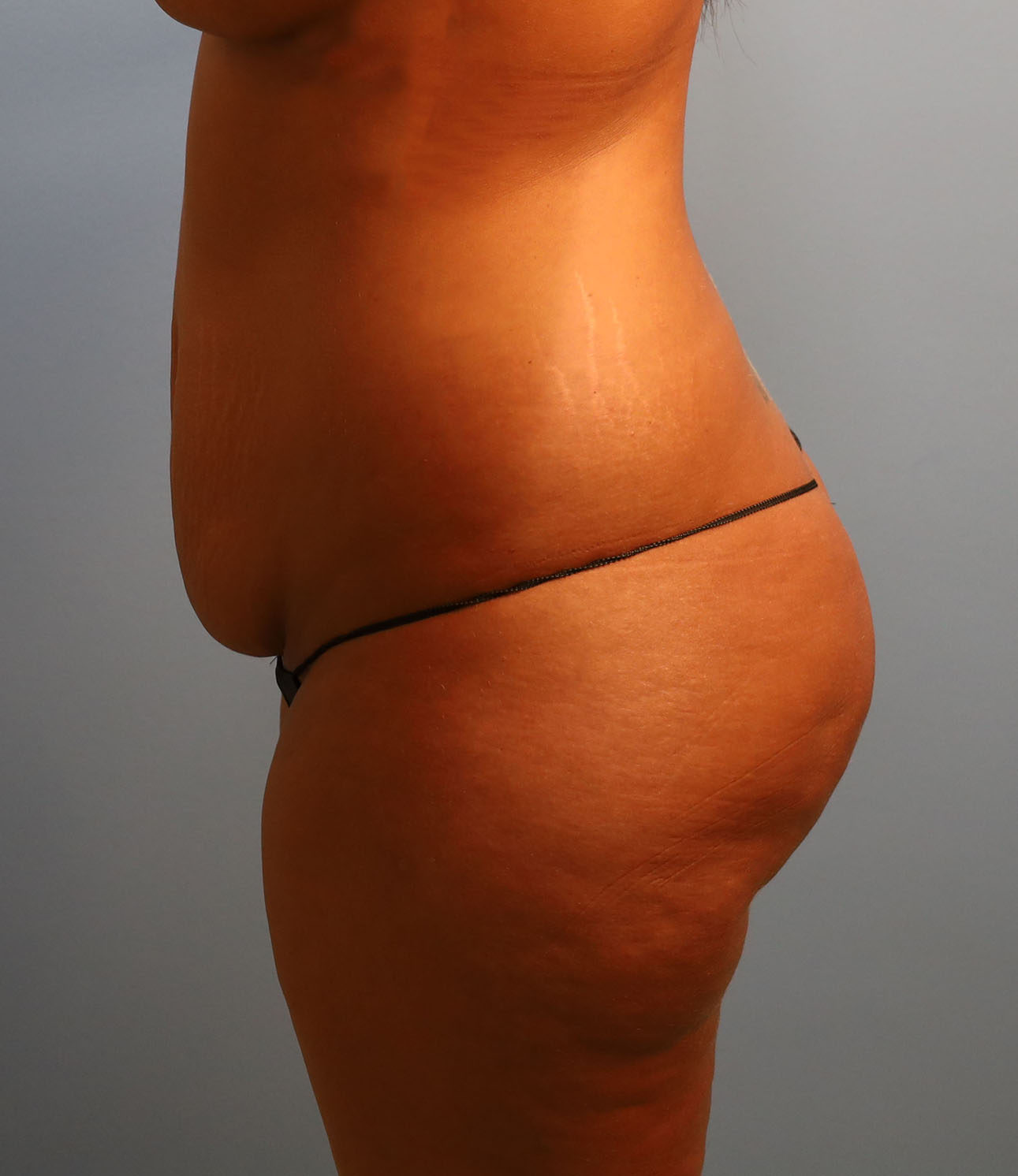 Before Image: Tummy Tuck - left-side