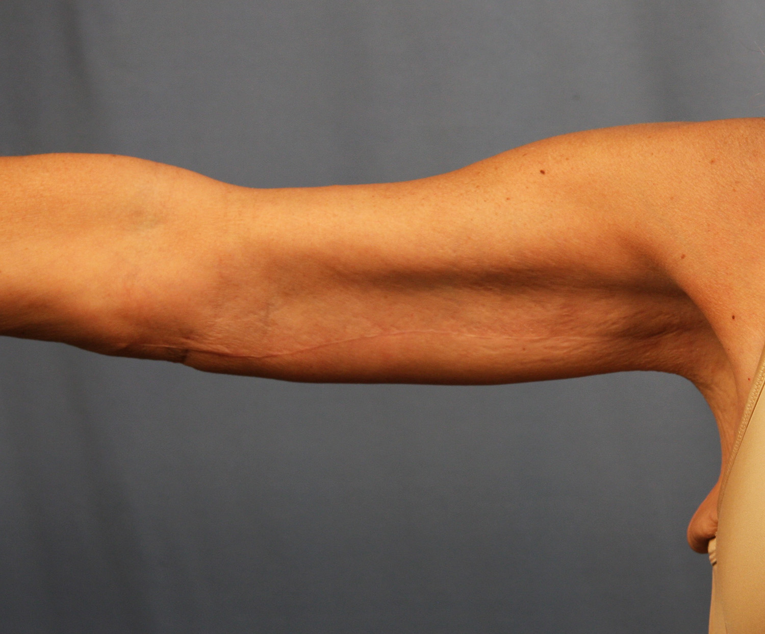 After Image: Brachioplasty - front