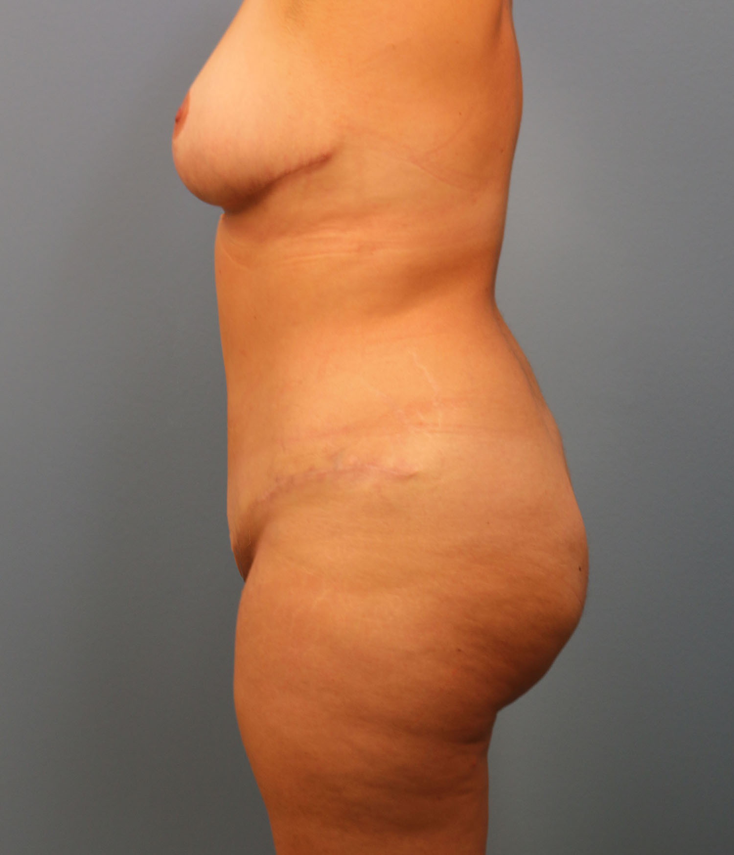 After Image: Breast Lift and Tummy Tuck - left-side