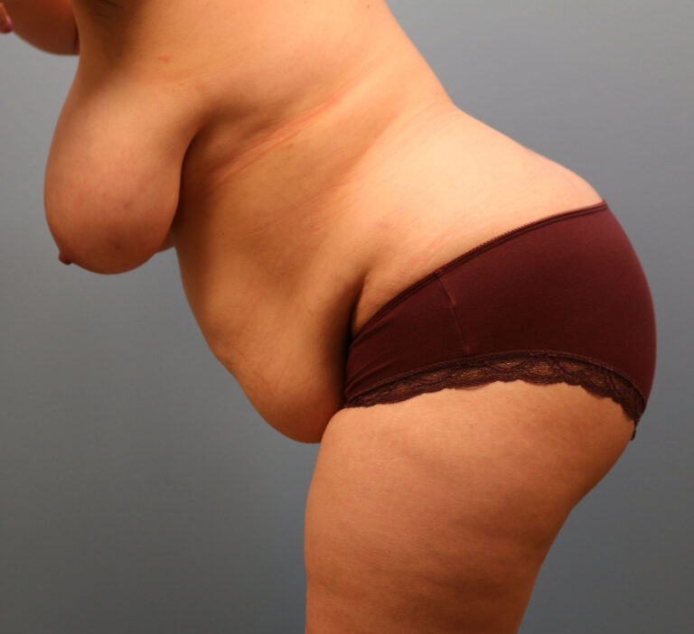 Before Image: Breast Lift and Tummy Tuck - other