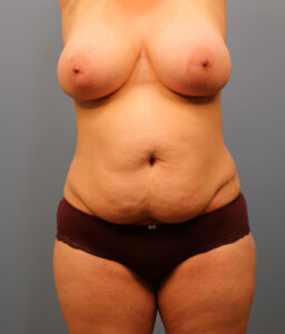 Before Image: Breast Lift and Tummy Tuck