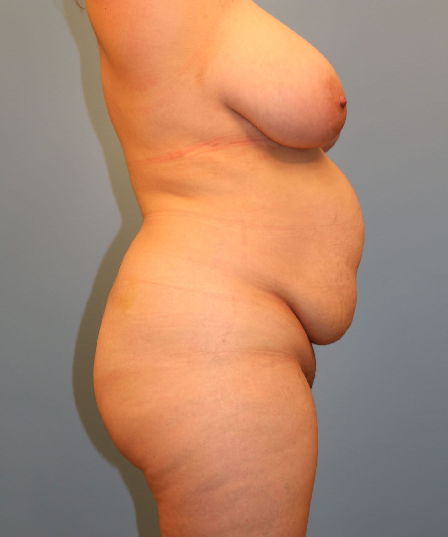 Before Image: Breast Lift and Tummy Tuck - right-side