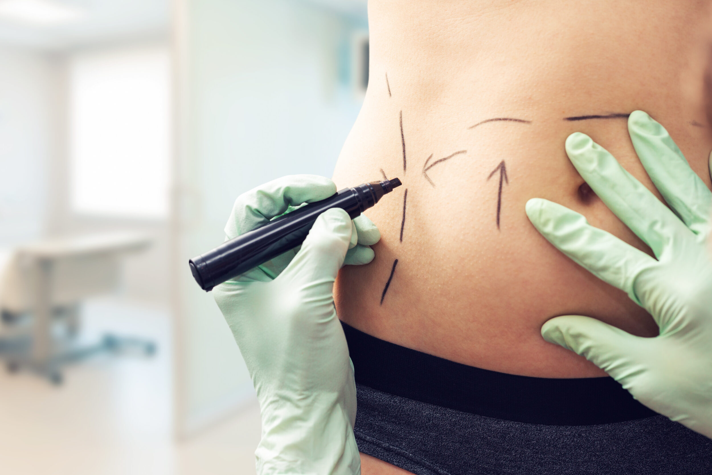 A surgeon marking a woman's stomach before tummy tuck surgery in Little Rock