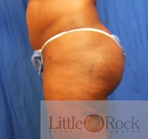 After Image: Brazilian Butt Lift