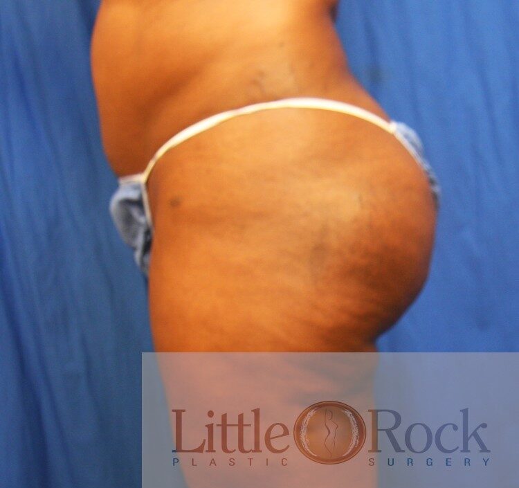 After Image: Brazilian Butt Lift - left-side