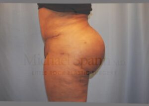 After Image: Brazilian Butt Lift