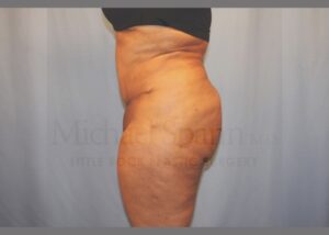 Before Image: Brazilian Butt Lift