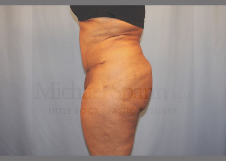 Before Image: Brazilian Butt Lift - left-side