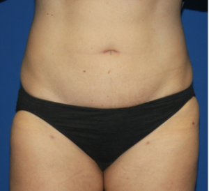 After Image: Liposuction - front