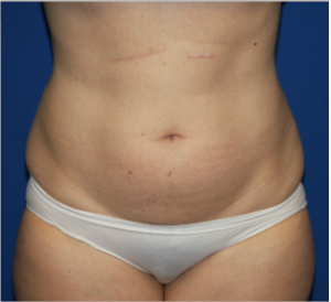 Before Image: Liposuction - front