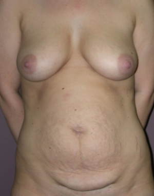 Before Image: Mommy Makeover - front