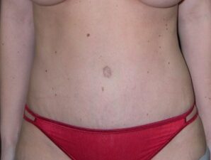 After Image: Tummy Tuck - front