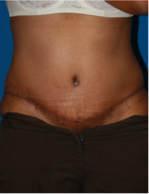 After Image: Tummy Tuck - front