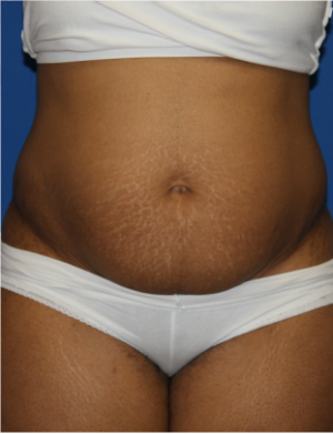 Before Image: Tummy Tuck - front