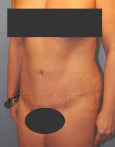 After Image: Tummy Tuck