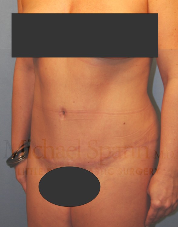 After Image: Tummy Tuck - left-front-oblique