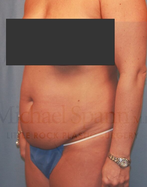 Before Image: Tummy Tuck - left-front-oblique